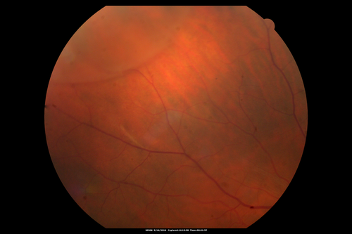 Bullous Retinoschisis - Confirmed with SD OCT
Atypical location for retinoschisis - SD-OCT is used to confirm that this is retinoschisis and not a retinal detachment

