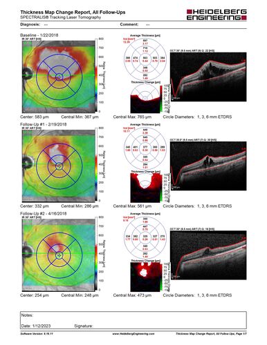 BRVO with late onset venous macroaneurysm
The vision improved on presentation from 20/160 - 20/32 with Avastin,  Then a few years later, he developed a venous Macroaneurysm which was lasered .  Avastin shots were then stopped.

