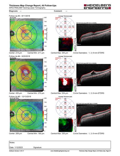 BRVO with late onset venous macroaneurysm
The vision improved on presentation from 20/160 - 20/32 with Avastin,  Then a few years later, he developed a venous Macroaneurysm which was lasered .  Avastin shots were then stopped.
