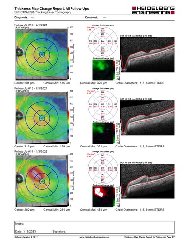 BRVO with late onset venous macroaneurysm
The vision improved on presentation from 20/160 - 20/32 with Avastin,  Then a few years later, he developed a venous Macroaneurysm which was lasered .  Avastin shots were then stopped.
