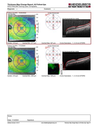 BRVO with late onset venous macroaneurysm
The vision improved on presentation from 20/160 - 20/32 with Avastin,  Then a few years later, he developed a venous Macroaneurysm which was lasered .  Avastin shots were then stopped.
