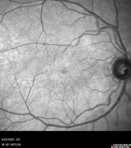 BRVO with late onset venous macroaneurysm
The vision improved on presentation from 20/160 - 20/32 with Avastin,  Then a few years later, he developed a venous Macroaneurysm which was lasered .  Avastin shots were then stopped.
