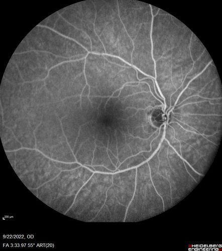 BRVO with late onset venous macroaneurysm
The vision improved on presentation from 20/160 - 20/32 with Avastin,  Then a few years later, he developed a venous Macroaneurysm which was lasered .  Avastin shots were then stopped.
