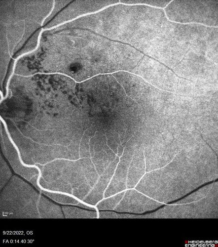 BRVO with late onset venous macroaneurysm
The vision improved on presentation from 20/160 - 20/32 with Avastin,  Then a few years later, he developed a venous Macroaneurysm which was lasered .  Avastin shots were then stopped.

