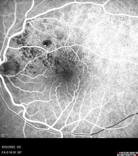 BRVO with late onset venous macroaneurysm
The vision improved on presentation from 20/160 - 20/32 with Avastin,  Then a few years later, he developed a venous Macroaneurysm which was lasered .  Avastin shots were then stopped.
