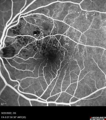 BRVO with late onset venous macroaneurysm
The vision improved on presentation from 20/160 - 20/32 with Avastin,  Then a few years later, he developed a venous Macroaneurysm which was lasered .  Avastin shots were then stopped.
