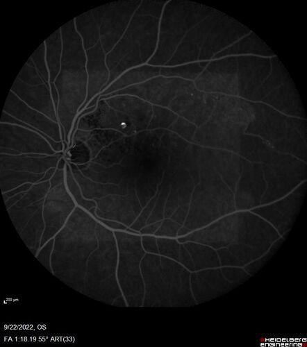 BRVO with late onset venous macroaneurysm
The vision improved on presentation from 20/160 - 20/32 with Avastin,  Then a few years later, he developed a venous Macroaneurysm which was lasered .  Avastin shots were then stopped.
