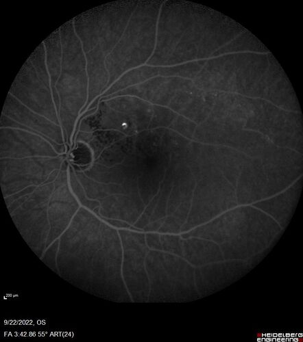 BRVO with late onset venous macroaneurysm
The vision improved on presentation from 20/160 - 20/32 with Avastin,  Then a few years later, he developed a venous Macroaneurysm which was lasered .  Avastin shots were then stopped.
