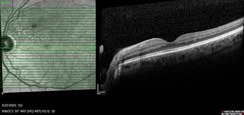 BRVO with late onset venous macroaneurysm
The vision improved on presentation from 20/160 - 20/32 with Avastin,  Then a few years later, he developed a venous Macroaneurysm which was lasered .  Avastin shots were then stopped.
