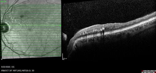 BRVO with late onset venous macroaneurysm
The vision improved on presentation from 20/160 - 20/32 with Avastin,  Then a few years later, he developed a venous Macroaneurysm which was lasered .  Avastin shots were then stopped.
