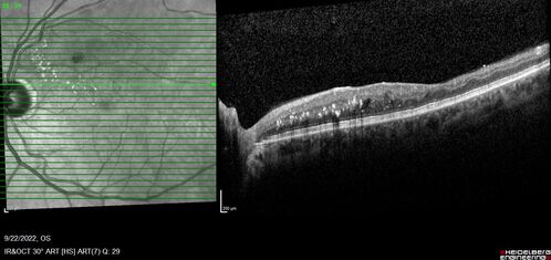 BRVO with late onset venous macroaneurysm
The vision improved on presentation from 20/160 - 20/32 with Avastin,  Then a few years later, he developed a venous Macroaneurysm which was lasered .  Avastin shots were then stopped.
