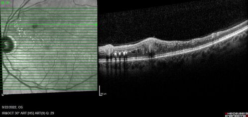 BRVO with late onset venous macroaneurysm
The vision improved on presentation from 20/160 - 20/32 with Avastin,  Then a few years later, he developed a venous Macroaneurysm which was lasered .  Avastin shots were then stopped.
