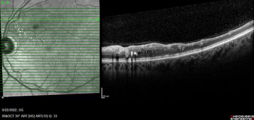 BRVO with late onset venous macroaneurysm
The vision improved on presentation from 20/160 - 20/32 with Avastin,  Then a few years later, he developed a venous Macroaneurysm which was lasered .  Avastin shots were then stopped.
