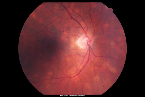 Sarcoidosis Multifocal Choroiditis
66 year old man with dense cataracts and recurrent uveitis.  Images show multifocal choroidal granulomas from sarcoidosis more in the right eye than the left eye.
