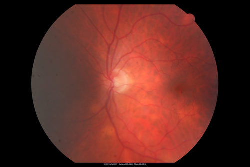 Sarcoidosis Multifocal Choroiditis
66 year old man with dense cataracts and recurrent uveitis.  Images show multifocal choroidal granulomas from sarcoidosis more in the right eye than the left eye.
