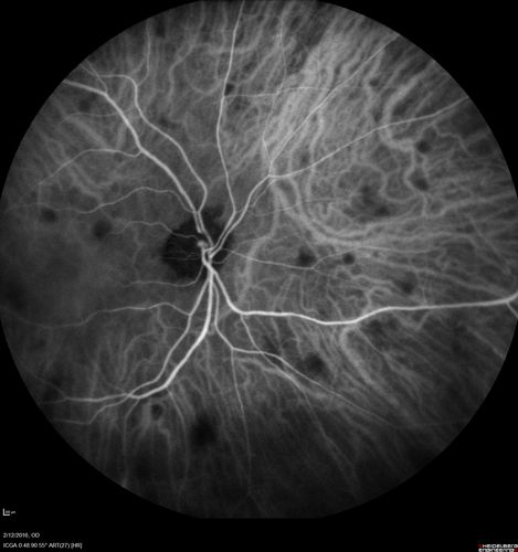 Sarcoidosis Multifocal Choroiditis
66 year old man with dense cataracts and recurrent uveitis.  Images show multifocal choroidal granulomas from sarcoidosis more in the right eye than the left eye.
