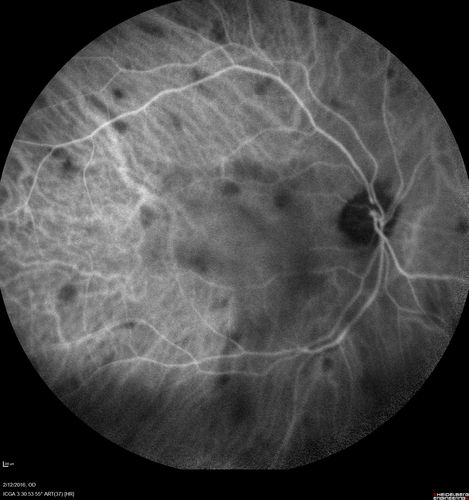 Sarcoidosis Multifocal Choroiditis
66 year old man with dense cataracts and recurrent uveitis.  Images show multifocal choroidal granulomas from sarcoidosis more in the right eye than the left eye.
