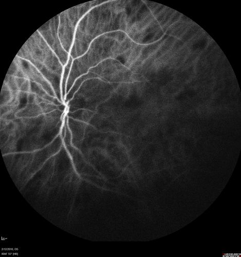 Sarcoidosis Multifocal Choroiditis
66 year old man with dense cataracts and recurrent uveitis.  Images show multifocal choroidal granulomas from sarcoidosis more in the right eye than the left eye.
