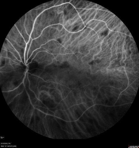 Sarcoidosis Multifocal Choroiditis
66 year old man with dense cataracts and recurrent uveitis.  Images show multifocal choroidal granulomas from sarcoidosis more in the right eye than the left eye.
