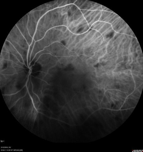 Sarcoidosis Multifocal Choroiditis
66 year old man with dense cataracts and recurrent uveitis.  Images show multifocal choroidal granulomas from sarcoidosis more in the right eye than the left eye.

