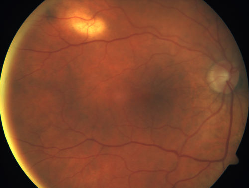 Sclerochoroidal Calcification and Peripheral Exudative Hemorrhagic Chorioretinopathy
67 year old man with asymptomatic peripheral subretinal hemorrhage associated with sclerochoroidal calcification.
VA 20/32 OU
