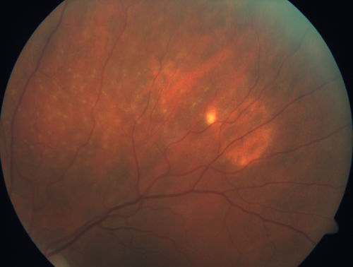 Sclerochoroidal Calcification and Peripheral Exudative Hemorrhagic Chorioretinopathy
67 year old man with asymptomatic peripheral subretinal hemorrhage associated with sclerochoroidal calcification.
VA 20/32 OU
