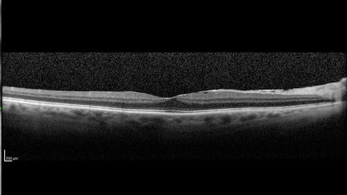 Sclerochoroidal Calcification and Peripheral Exudative Hemorrhagic Chorioretinopathy
67 year old man with asymptomatic peripheral subretinal hemorrhage associated with sclerochoroidal calcification.
VA 20/32 OU
