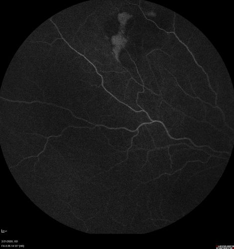 Sclerochoroidal Calcification and Peripheral Exudative Hemorrhagic Chorioretinopathy
67 year old man with asymptomatic peripheral subretinal hemorrhage associated with sclerochoroidal calcification.
VA 20/32 OU
