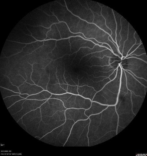 Sclerochoroidal Calcification and Peripheral Exudative Hemorrhagic Chorioretinopathy
67 year old man with asymptomatic peripheral subretinal hemorrhage associated with sclerochoroidal calcification.
VA 20/32 OU
