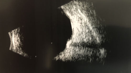 Sclerochoroidal Calcification and Peripheral Exudative Hemorrhagic Chorioretinopathy
67 year old man with asymptomatic peripheral subretinal hemorrhage associated with sclerochoroidal calcification.
VA 20/32 OU
