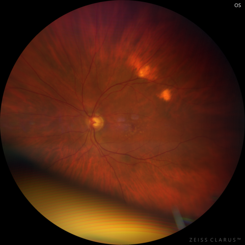 Sclerochoroidal Calcification - Large Lesion
77 year old white male retired physician.  The patient was noticing a change in vision and saw you for a checkup.Â  He used to see better from a distance without glasses and now he takes his glasses off to read.Â  There is a mass in the right eye.Â Â 
VA OD: Dcc20/50-1 PH20/40-1 NccJ1
VA OS: Dcc20/32+1 NccJ1-1
IOP: TP: OD:14 OS:15
