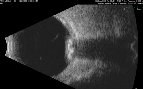 Sclerochoroidal Calcification - Large Lesion
77 year old white male retired physician.  The patient was noticing a change in vision and saw you for a checkup.Â  He used to see better from a distance without glasses and now he takes his glasses off to read.Â  There is a mass in the right eye.Â Â 
VA OD: Dcc20/50-1 PH20/40-1 NccJ1
VA OS: Dcc20/32+1 NccJ1-1
IOP: TP: OD:14 OS:15
