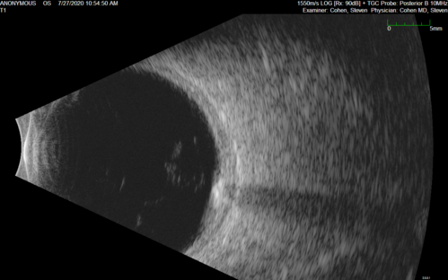 Sclerochoroidal Calcification - Large Lesion
77 year old white male retired physician.  The patient was noticing a change in vision and saw you for a checkup.Â  He used to see better from a distance without glasses and now he takes his glasses off to read.Â  There is a mass in the right eye.Â Â 
VA OD: Dcc20/50-1 PH20/40-1 NccJ1
VA OS: Dcc20/32+1 NccJ1-1
IOP: TP: OD:14 OS:15
