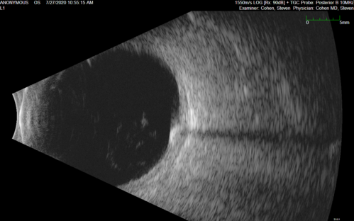 Sclerochoroidal Calcification - Large Lesion
77 year old white male retired physician.  The patient was noticing a change in vision and saw you for a checkup.Â  He used to see better from a distance without glasses and now he takes his glasses off to read.Â  There is a mass in the right eye.Â Â 
VA OD: Dcc20/50-1 PH20/40-1 NccJ1
VA OS: Dcc20/32+1 NccJ1-1
IOP: TP: OD:14 OS:15
