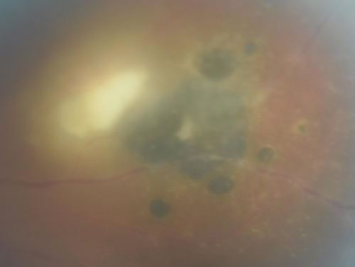 Toxoplasmosis - Recurrent - Moderate Vitritis
32 year old woman with 20/80 vision and moderately painful red eye in the left eye only.  The left eye had some redness about 10 years ago.  She is a native of Sierra Leone
