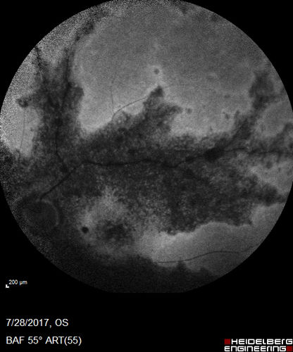 Pigmented Paravenous Retinochoroidal Atrophy - Left Eye
70 year old woman lost vision OS 20 years ago.
