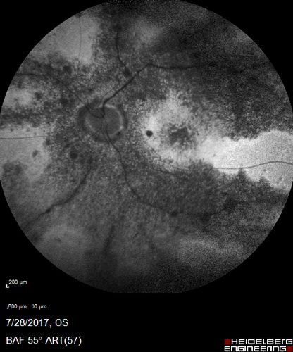 Pigmented Paravenous Retinochoroidal Atrophy - Left Eye
70 year old woman lost vision OS 20 years ago.

