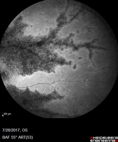 Pigmented Paravenous Retinochoroidal Atrophy - Left Eye
70 year old woman lost vision OS 20 years ago.
