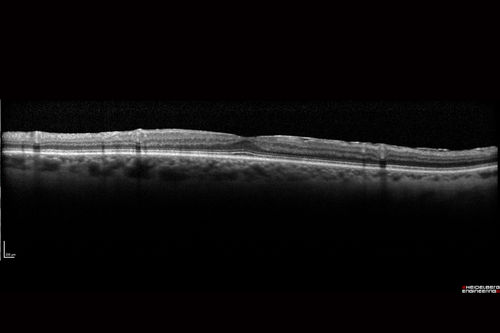Pigmented Paravenous Retinochoroidal Atrophy - Left Eye
70 year old woman lost vision OS 20 years ago.
