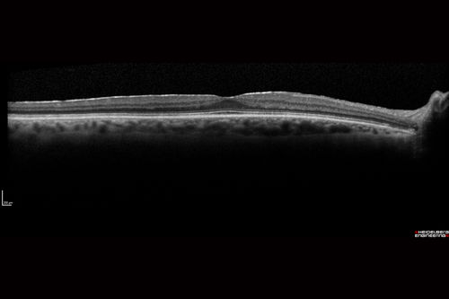 Pigmented Paravenous Retinochoroidal Atrophy - Left Eye
70 year old woman lost vision OS 20 years ago.

