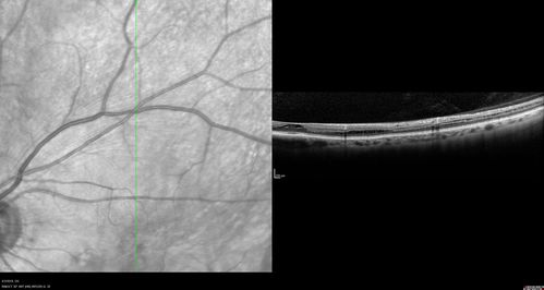 Stellate Non-heredtiary Idiopathic Foveomacular Retinoschisis (SNIFR)
77 year old man who is healthy and 6'6