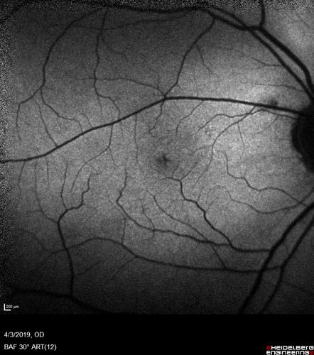 Stellate Non-heredtiary Idiopathic Foveomacular Retinoschisis (SNIFR)
77 year old man who is healthy and 6'6