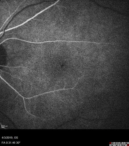 Stellate Non-heredtiary Idiopathic Foveomacular Retinoschisis (SNIFR)
77 year old man who is healthy and 6'6