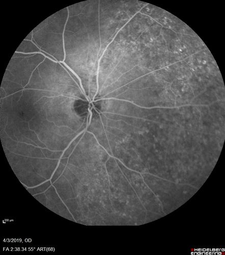 Stellate Non-heredtiary Idiopathic Foveomacular Retinoschisis (SNIFR)
77 year old man who is healthy and 6'6
