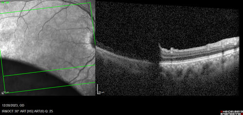 schisis-octline.jpg