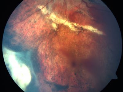 Sclopteria Chorioretinitis - 16 Year Old Girl - Pellet Injury
Keywords: trauma; scar; sclopteria chorioretinitis; non-penetrating; non-perforating