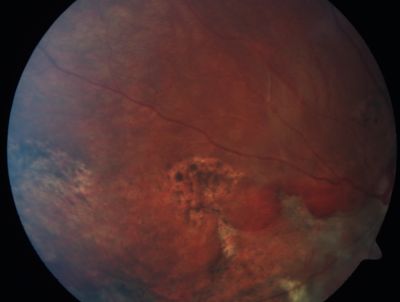 Sclopteria Chorioretinitis - 16 Year Old Girl - Pellet Injury
Keywords: trauma; scar; sclopteria chorioretinitis; non-penetrating; non-perforating