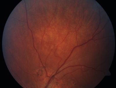 Sclopteria Chorioretinitis - 16 Year Old Girl - Pellet Injury
