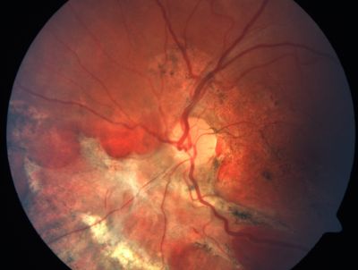 Sclopteria Chorioretinitis - 16 Year Old Girl - Pellet Injury

