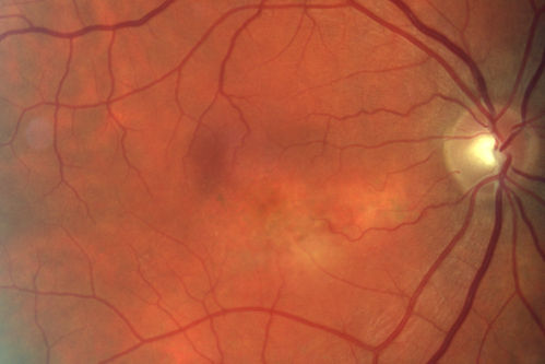Serous Macular Detachment Both Eyes - Wet AMD vs. CSR - 62 Year Old Man - Color Photo

